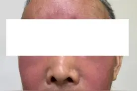 杭州发生多起！面部肿成“馒头”！6小时内处理很重要图片