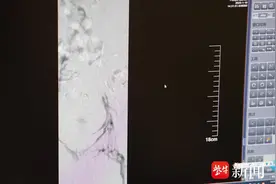 23岁毕业生每天久坐赶论文，突发下肢静脉血栓图片