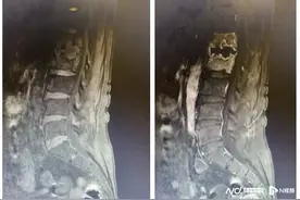 腰痛反反复复，“元凶”竟是腰椎感染？医生提醒了图片