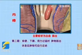 十人九痔 如何知道自己是不是得了痔疮？图片