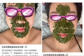 餐桌上常见的马齿苋，也能用来敷脸消炎？专家：对皮炎湿疹有效，但需注意浓度和时间|网红说法求真图片