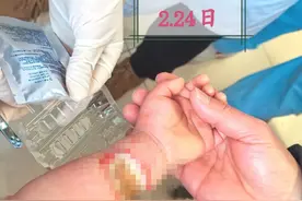 1岁幼童被502胶水“烧伤” 局部皮肤坏死需植皮图片