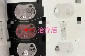 一年间确诊结直肠癌晚期并发生肝转移，两个月峰回路转肿瘤标记物降幅超80%图片