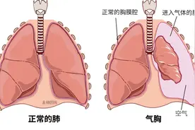 别大意！突发胸痛警惕这种疾病，3类高危人群尤其要注意→图片