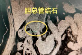 93岁婆婆胆管结石引发高烧腹痛“警报”，医生妙用微创ERCP技术“精准拆弹”图片