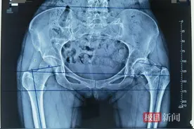 女子股骨头坏死多年，她在协和车谷院区换了髋关节，两个月后重返健身房图片