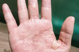 福州女子因爱美做了这事，两三天后竟奇痒难忍！医生：近期每天接诊多例图片
