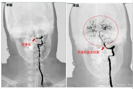 “头晕”背后的危机，警惕后循环缺血图片
