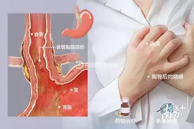 胃食管反流反酸烧心？内镜微创手术10分钟即可缓解图片
