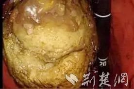 女子反复腹痛反酸呕吐 竟是胃里“鸭梨山大” 医生提醒：山楂虽好吃 但切勿贪食图片