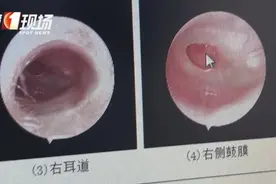 1岁半宝宝“脑脊液”从耳朵流出，只因模仿大人做了这个动作……图片