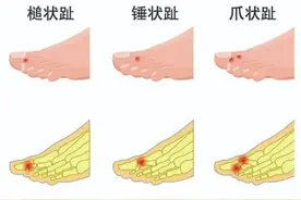 脚长歪了是脚的错吗？这3种畸形都是穿鞋穿出来的！图片