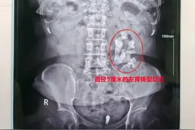 女子患肾结石不痛就掉以轻心，如今长成“生姜”填满肾脏图片