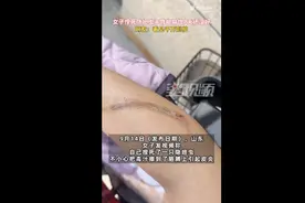女子捏死隐翅虫手臂被腐蚀7天还没好，网友：会反复溃烂图片