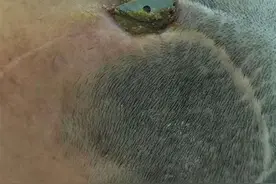 老人颅骨修补材料“破头而出”，武汉专家巧施“头顶翻修术”图片