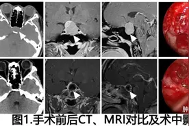 哈尔滨医科大学附属第一医院神经外科二病房成功实施多例内镜经鼻蝶窦垂体瘤微创切除图片