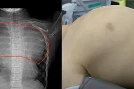男孩“鸡胸”竟是隐藏的巨大肿瘤，新华心脏专家5小时“拆弹”图片