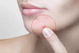 痘痘成熟了能挤吗？图片