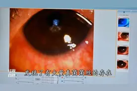 小心，只因一个动作，婆婆眼睛真菌感染！湖北已发生多起！图片