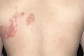 50岁以上要注意，女子拆快递后确诊感染，疼痛难忍！具有传染性，超九成人体内潜伏图片