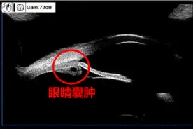 受高度近视+高散光多年困扰，飞秒ICL晶体植入术助她重获清晰视界图片