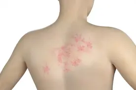 传染性强！接触后约90%都会发病！注意这个病毒~图片