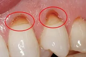 不可忽视的口腔问题——楔状缺损图片