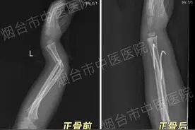 儿童骨折不开刀，烟台市中医医院中医正骨有妙招图片
