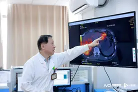 中晚期肝癌治疗新方法：给肿瘤精准投放钇90“核弹”图片