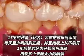 17岁女孩一天5瓶可乐泡腐15颗牙 医生警告：长期大量饮用会伤牙图片