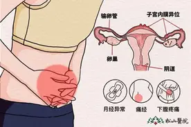 3年间复发3次？松山医院：子宫内膜异位症需长期规范化治疗图片