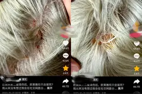 在欧莱雅旗舰店漂染发却造成头皮二度烧伤？门店：协商沟通中图片