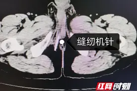 衡阳市中心医院：钢针插入尿道引起不适 医生妙手取针解除痛苦图片