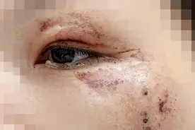 眼皮腐烂，差点毁容！遇到它，请绕道图片