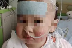 极目帮办|一岁半女童误食疏通剂引发严重灼伤，高昂治疗费用掏空家底，希望爱心人士伸出援助之手图片