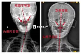 8岁男童“落枕”了，一查竟是颈椎半脱位图片