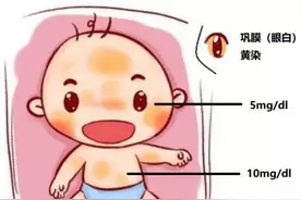认识新生儿黄疸图片