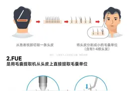 科普｜植发手术后多久能长出头发？做一次就行吗？图片