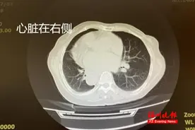罕见！福州依姆竟是“镜面人”！一辈子无症状，医生却紧张……图片