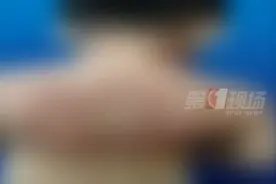 母子俩起皮疹大半年，竟是衣服“没洗对”？！图片