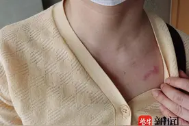 摘除甲状腺医生有高招：伤口能“隐身”图片