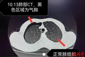 24岁小伙睡梦中肺“炸了”?医生：这类男生要当心图片