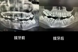 女子疑因“拔错智齿又被塞回”坠楼身亡，最后一条动态曝光！最新消息图片