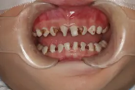全国爱牙日丨“坏牙”多，孩子怕看牙？儿童全麻下口腔舒适化治疗了解一下图片