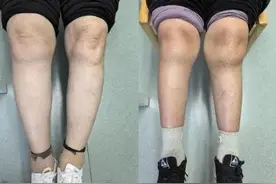 关于X型腿和O型腿的这些知识，你了解吗？图片