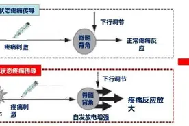 健康科普 | 如何预防急性疼痛向慢性疼痛转化图片