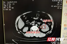女子腰痛频发仅依靠止痛药支撑 今突发畏寒发热才揪出疼痛根源图片