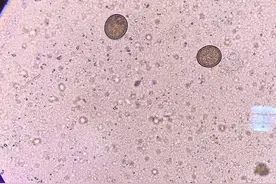 触目惊心！男子持续腹痛，排出2.73米长的“虫子”……医生紧急提醒图片