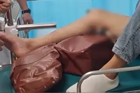 骨科求助！高空跌落，男子腿部被钢筋无情贯穿图片