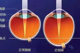 高度近视会遗传吗？超过这个度数可产生一定的遗传因素图片
